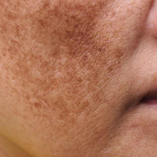 Dark Spots & Pigmentation