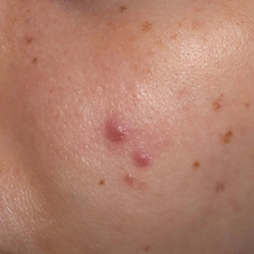 Acne